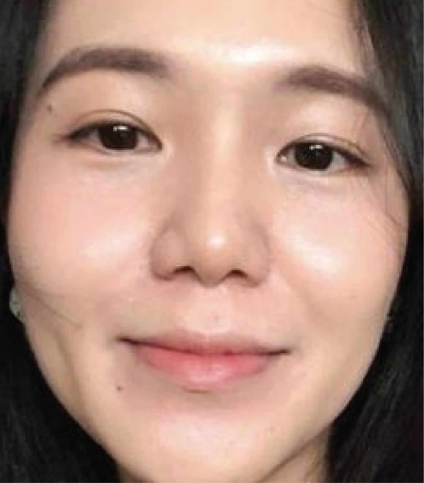 hình ảnh trước và sau khi làm IPL