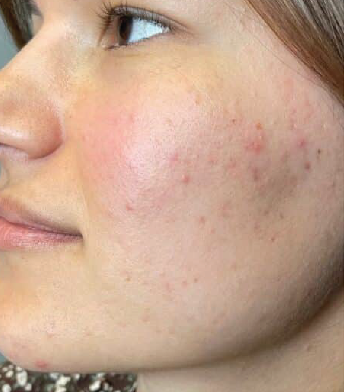 hình ảnh trước & sau khi thực hiện IPL