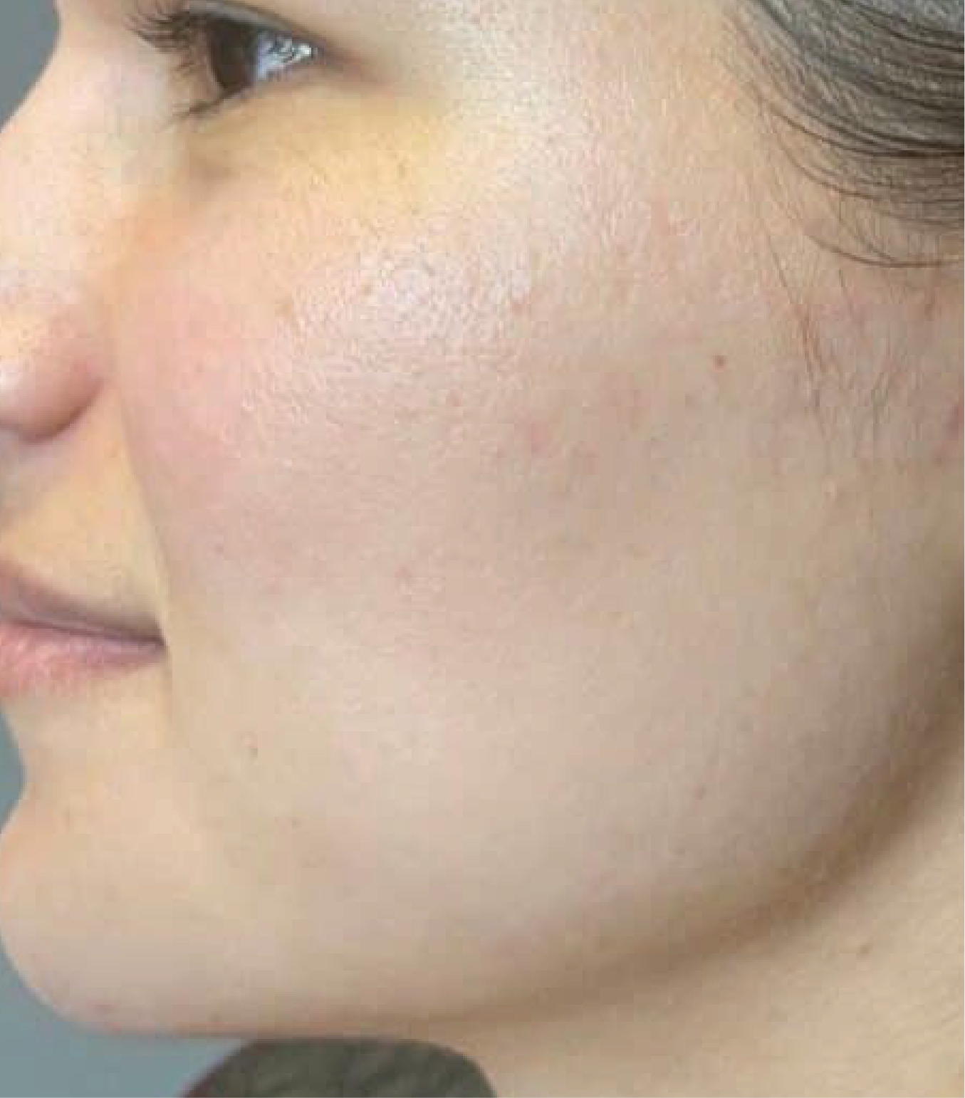 hình ảnh trước & sau khi thực hiện IPL