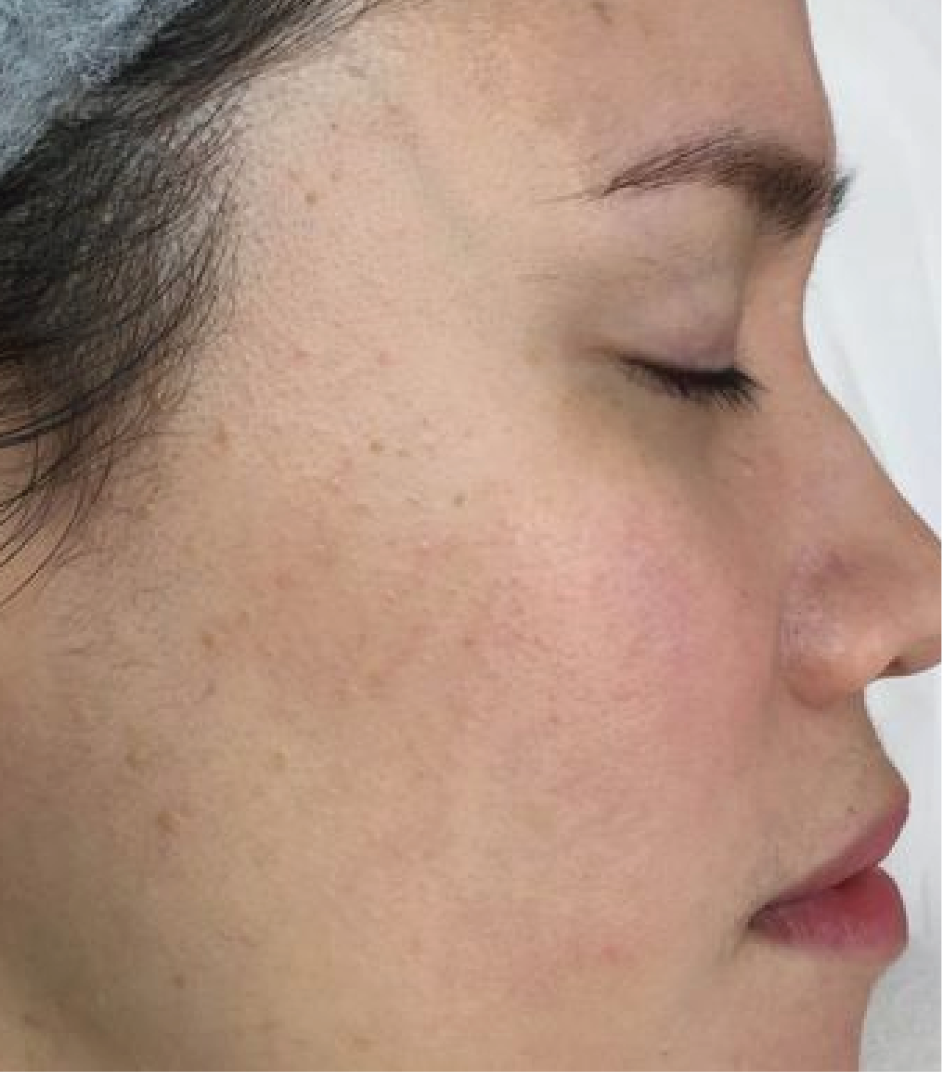 hình ảnh trước & sau khi thực hiện Meso Exocode