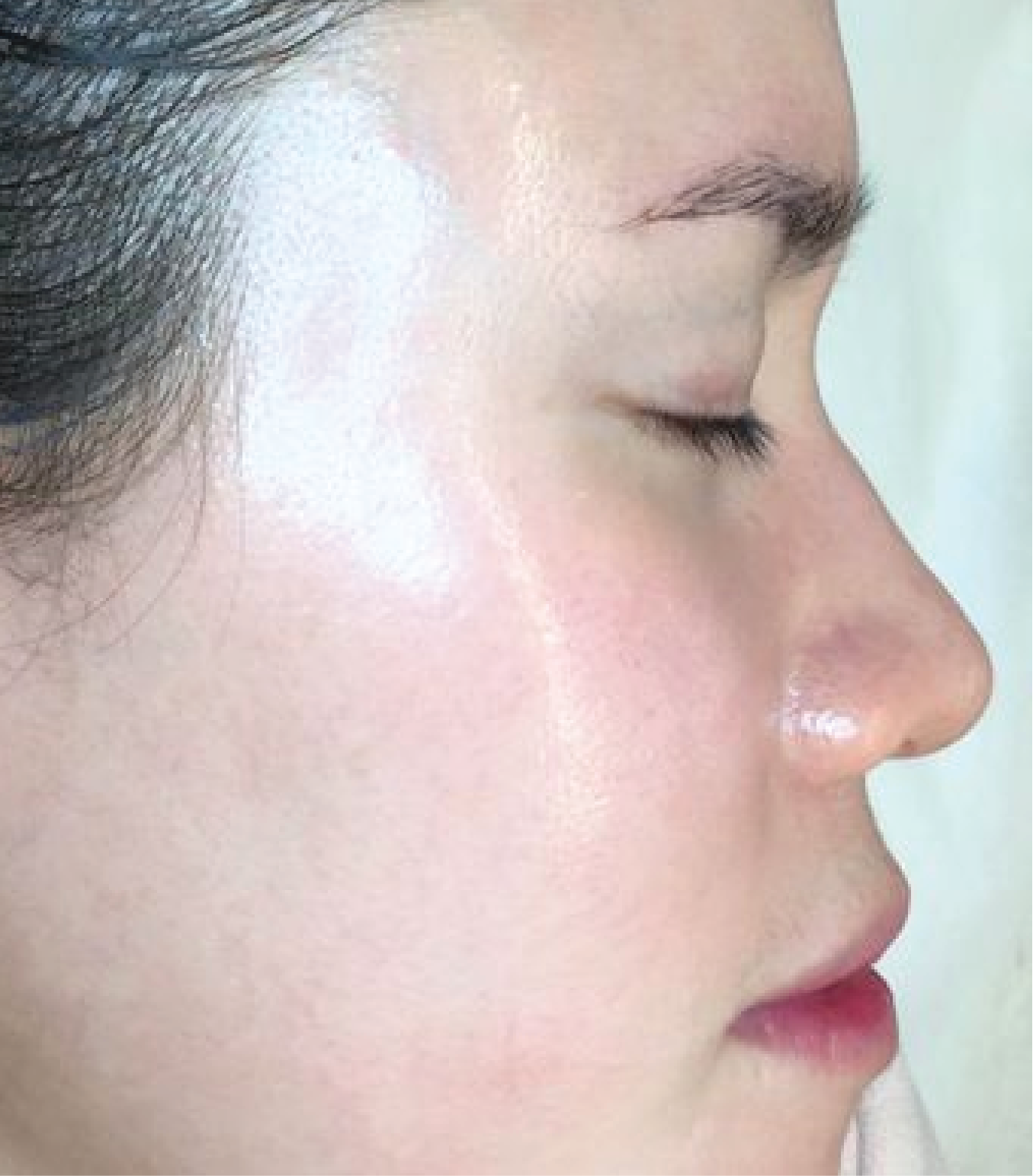 hình ảnh trước & sau khi thực hiện Meso Exocode