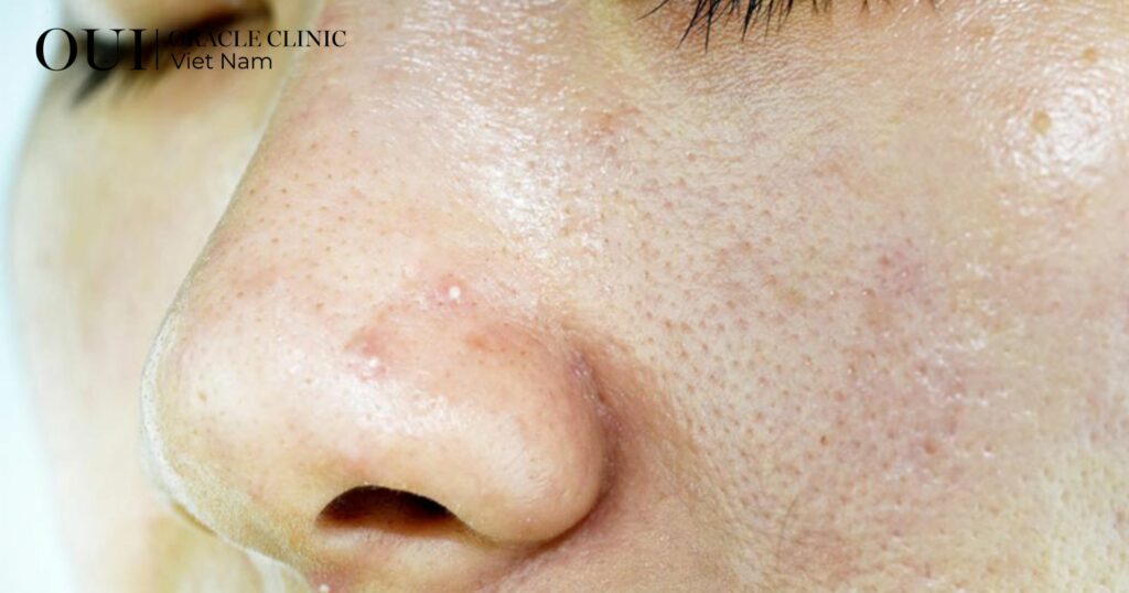 cách cấp ẩm cho da mùa hè da đổ dầu nhiều