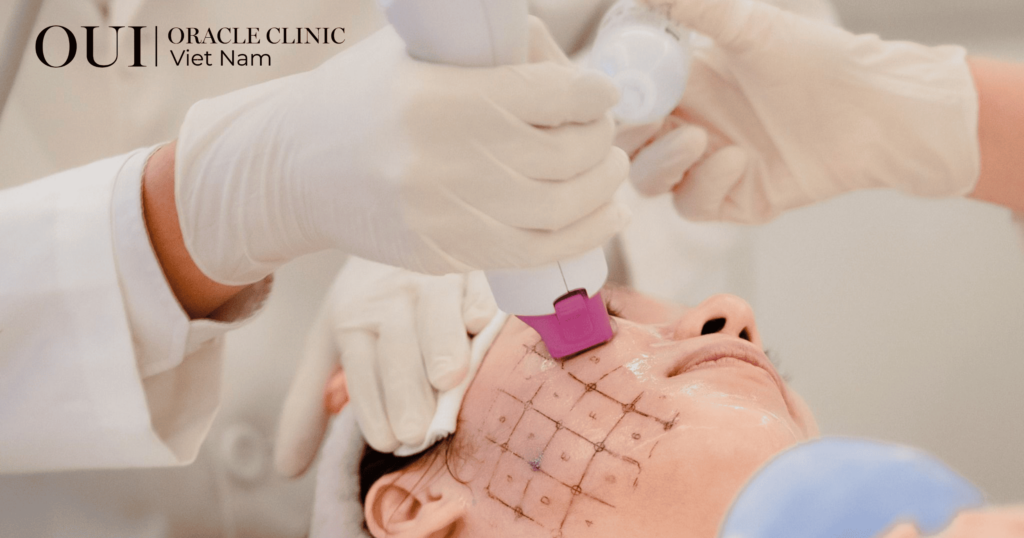 chống lão hóa mùa hè công nghệ thermage FLX