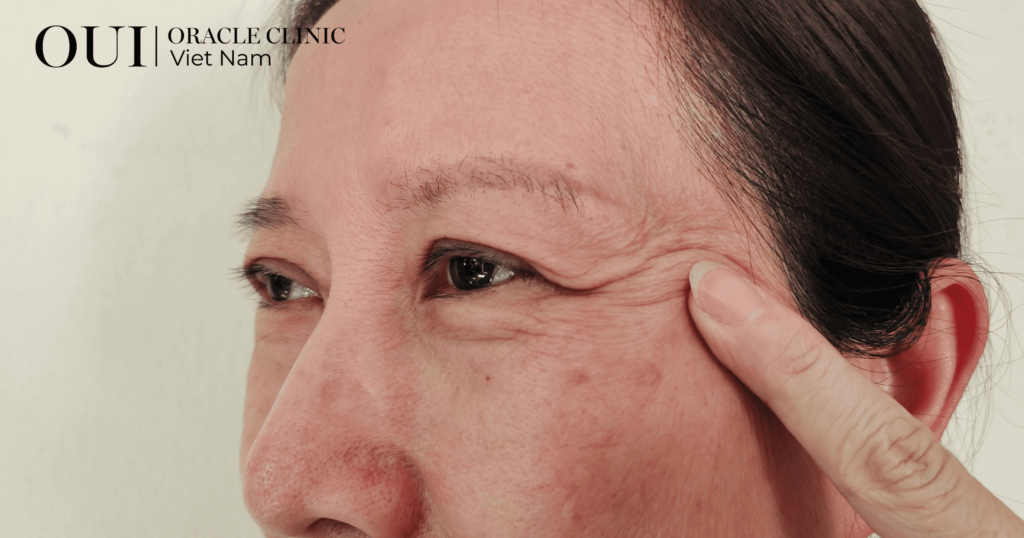 chống lão hóa mùa hè khi có nếp nhăn