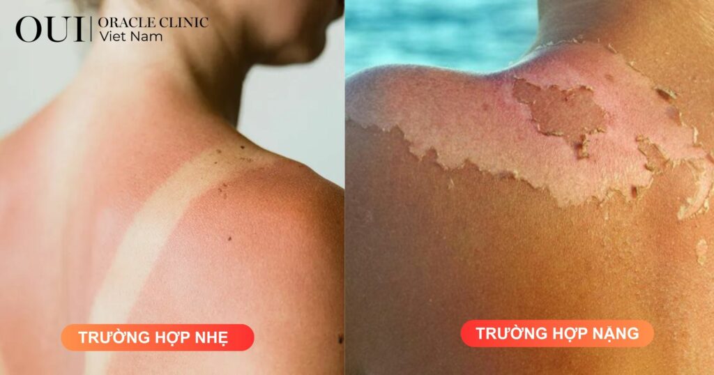 bị sạm đen do nắng có hồi lại không các trường hợp