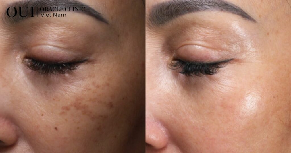 da bị sạm đen do nắng có hồi lại không