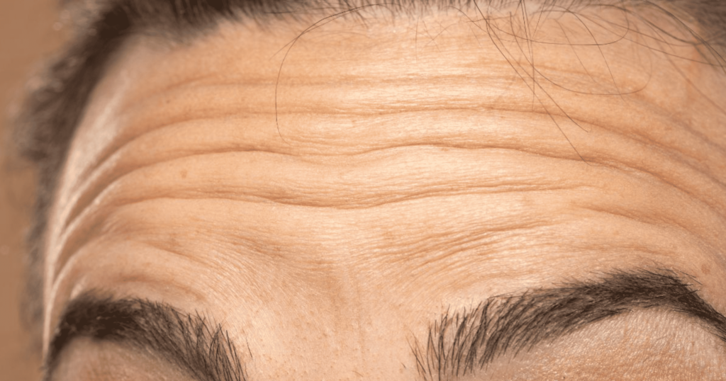 da mất đàn hồi nếp nhăn hằn sâu rõ rệt