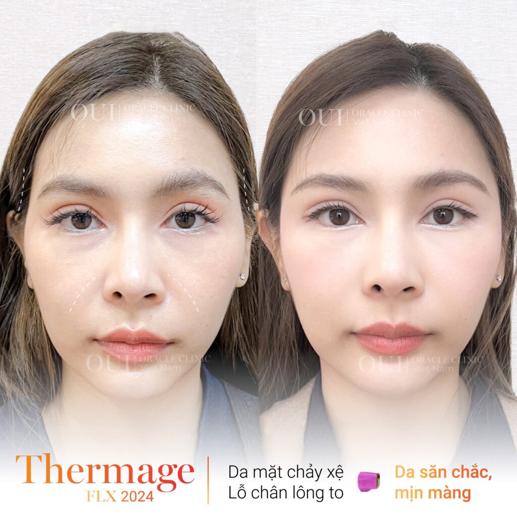 hình ảnh trước và sau khi cải thiện da mất đàn hồi