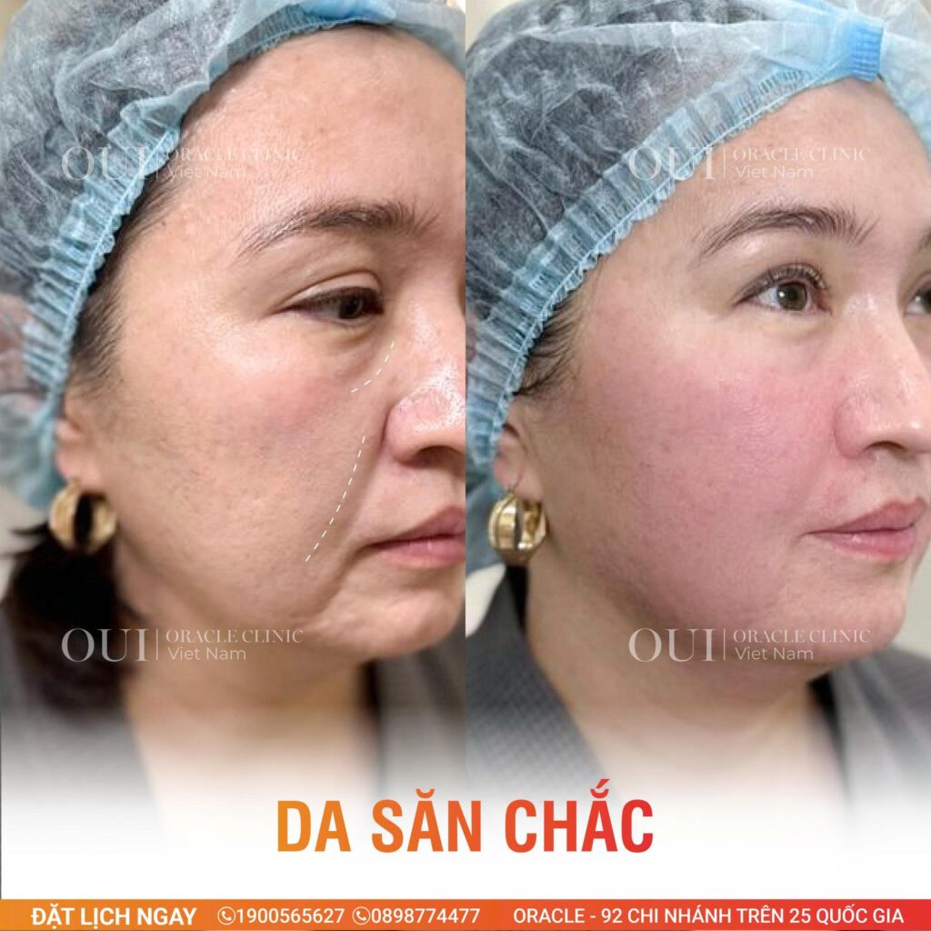 hình ảnh trước và sau khi cải thiện da mất đàn hồi