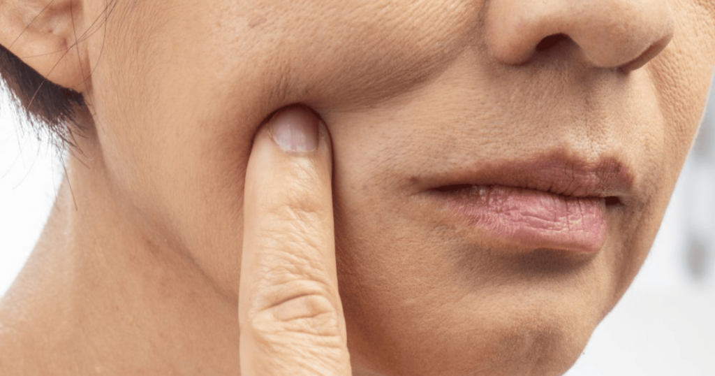 da mất đàn hồi da chảy xệ