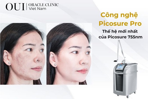 Laser trị nám có bị bắt nắng không công nghệ điều trị nám Picosure Pro