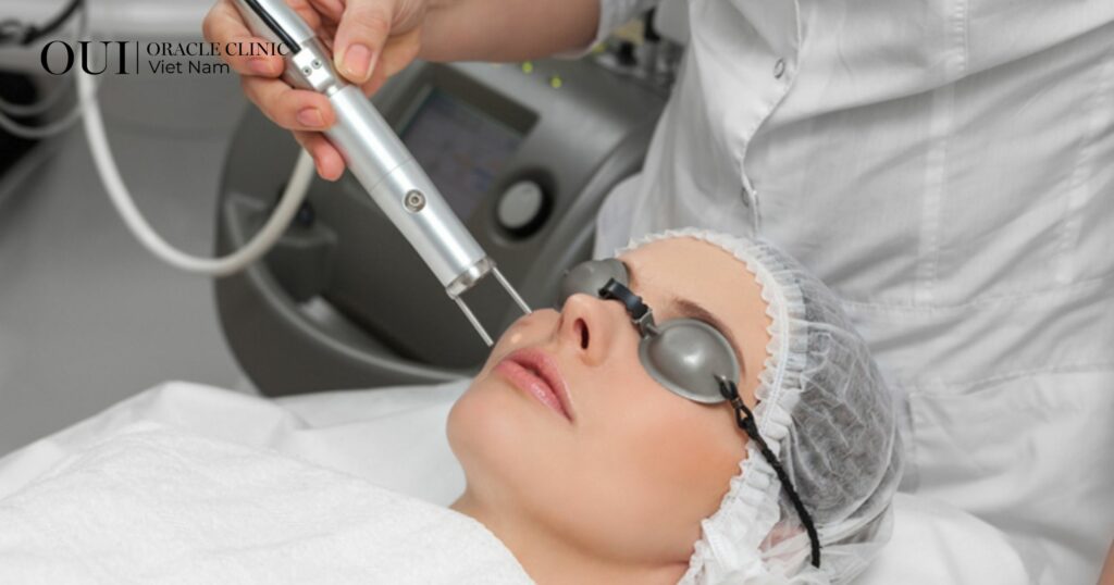 Laser trị nám có bị bắt nắng không