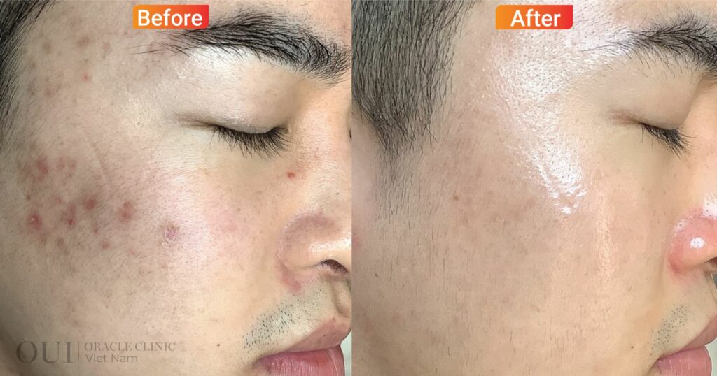 Laser trị nám có bị bắt nắng không trước và sau