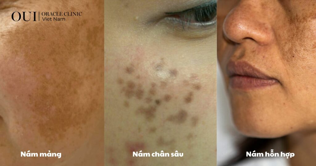 laser trị nám có bị bắt nắng không