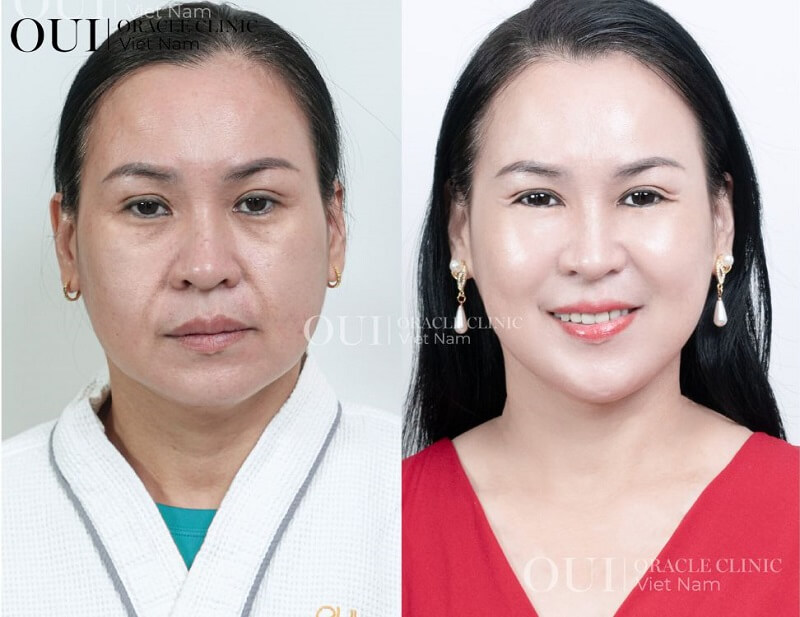 Thermage có bị hóp má không trước và sau khi thực hiện điều trị