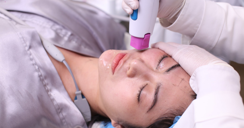 thermage có bị hóp má không sử dụng sóng tần số vô tuyến