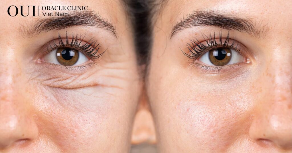 tiêm botox đuôi mắt duy trì được bao lâu 