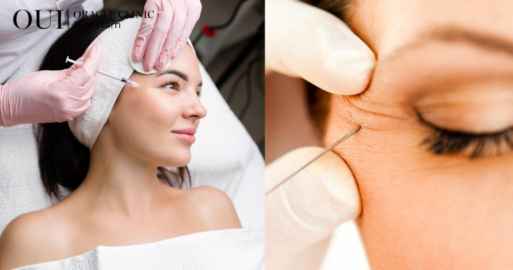 tiêm botox đuôi mắt duy trì được bao lâu khái niệm