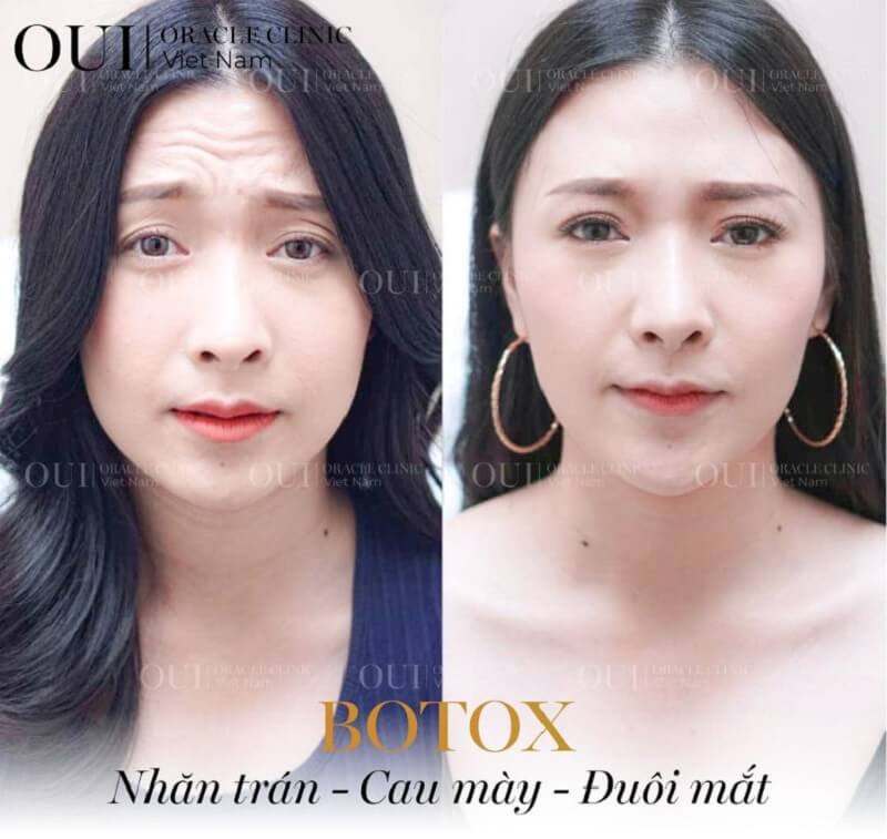 tiêm botox giữ được bao lâu