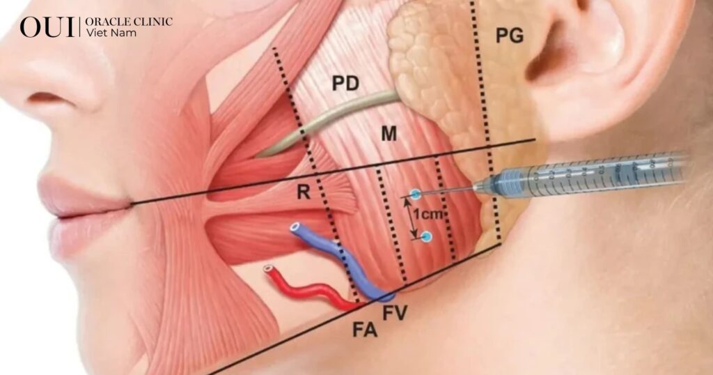 tiêm botox giữ được bao lâu do vị trí và kích thước vùng tiêm