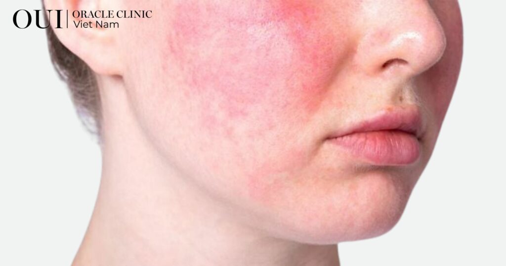 tiêm meso cấp ẩm