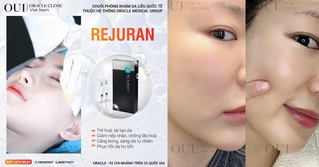 tiêm meso cấp ẩm rejuran
