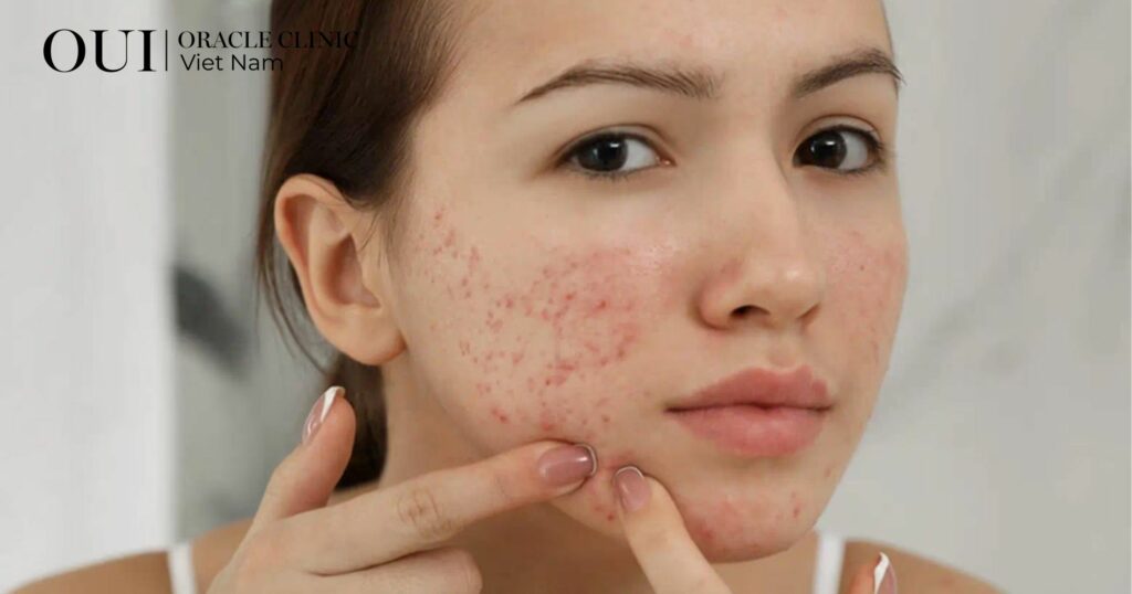 trị thâm mụn bao lâu thì hết