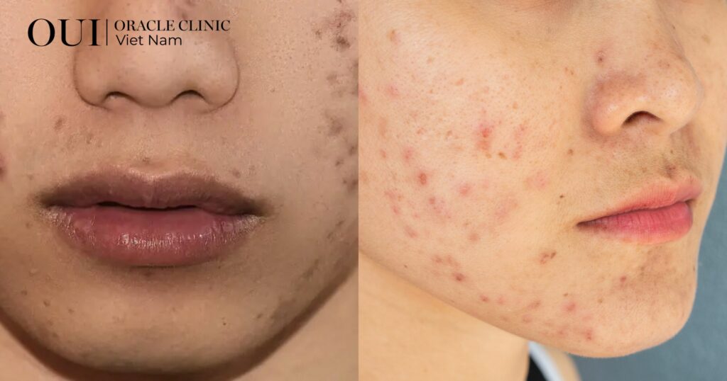 trị thâm mụn bao lâu thì hết da đổi màu sau mụn