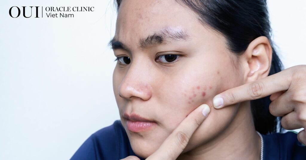 Trị thâm mụn bao lâu thì hết sai lầm khiến thâm mụn không hết