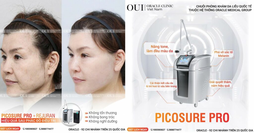 Trị thâm mụn bao lâu thì hết ứng dụng công nghệ Laser