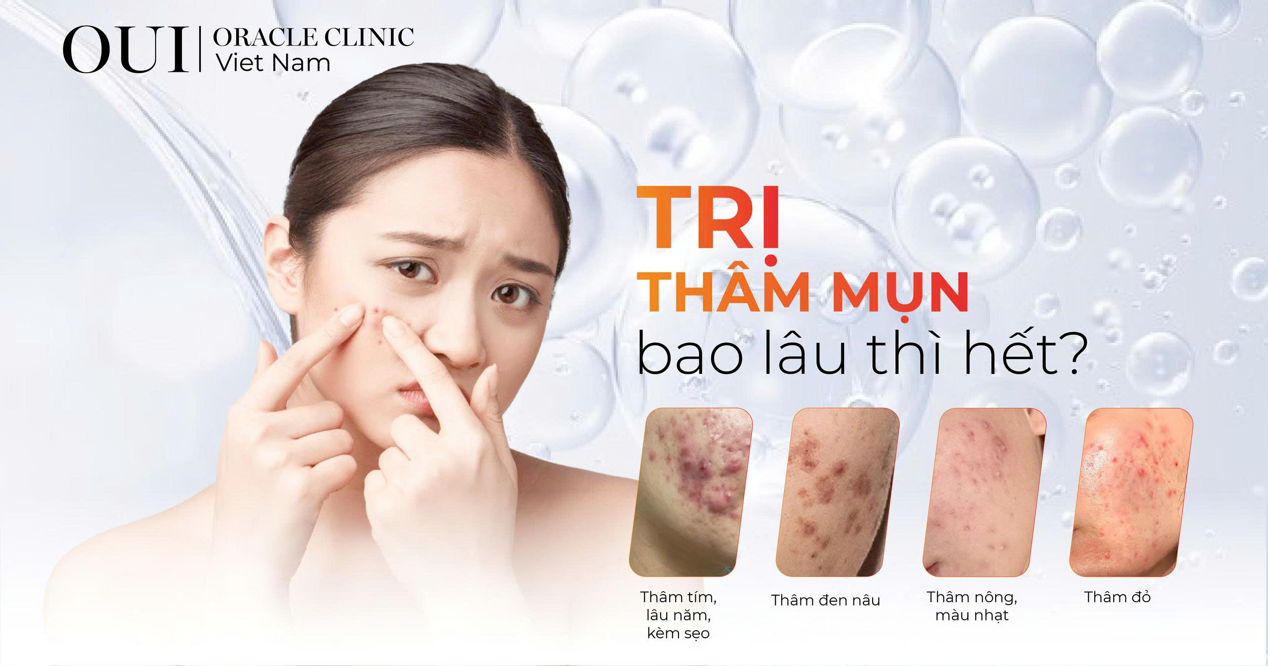 trị thâm mụn bao lâu thì hết