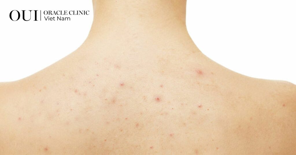 Triệt lông trước khi đi biển bao lâu