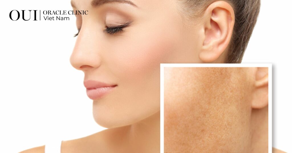 Triệt lông trước khi đi biển bao lâu