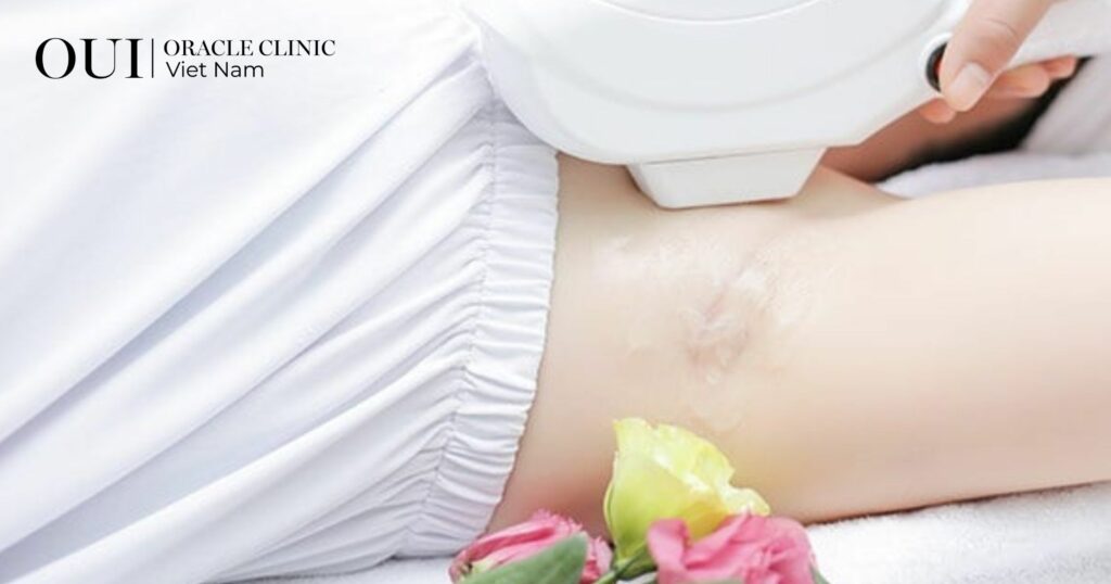 Triệt lông trước khi đi biển bao lâu