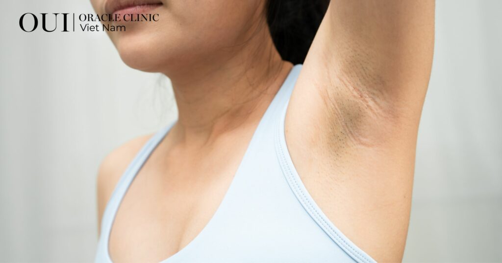 Triệt lông xong có bị bắt nắng không nguy cơ thâm sạm