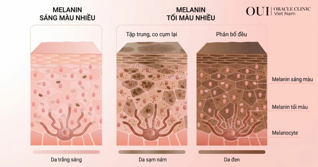 Triệt lông xong có bị bắt nắng không kích thích tăng sinh Melanin quá mức