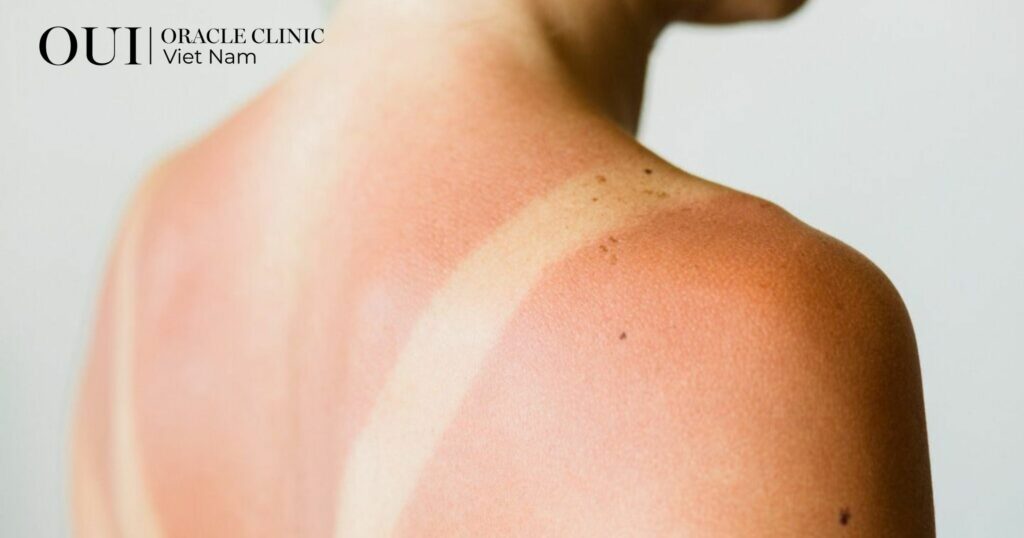 Triệt lông xong có bị bắt nắng không gây viêm da do ánh nắng