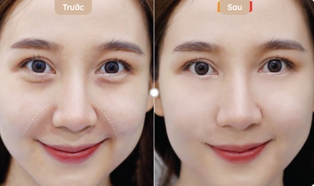 Nâng cơ có bị chảy xệ lại không