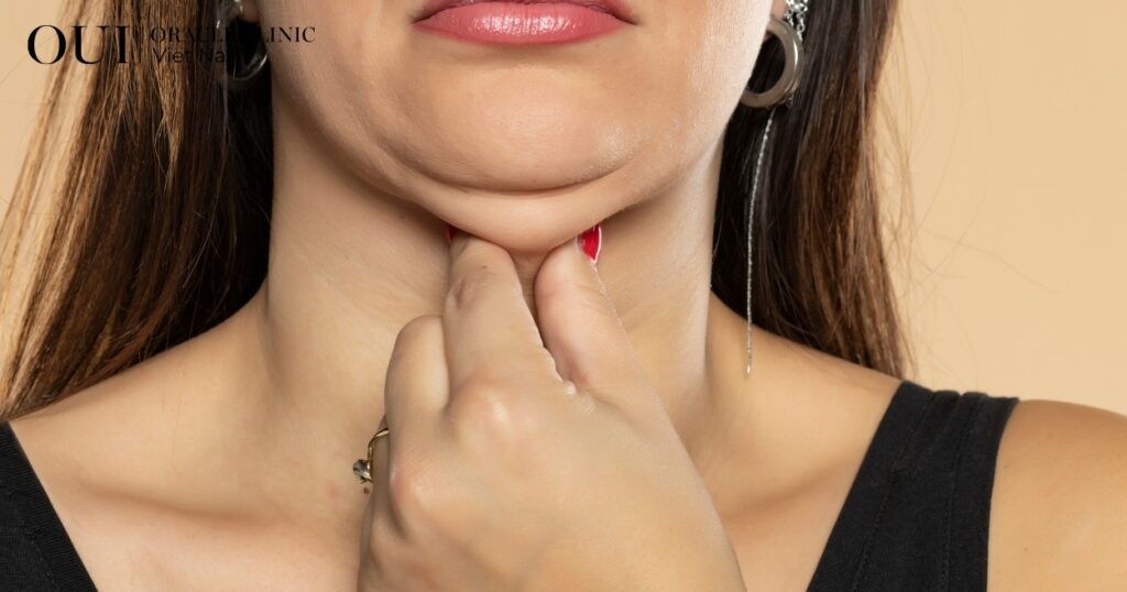 cách giảm nọng cằm nhanh
