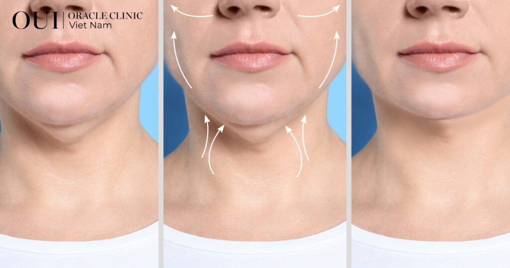 cách giảm nọng cằm nhanh