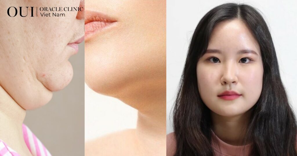 cách giảm nọng cằm nhanh
