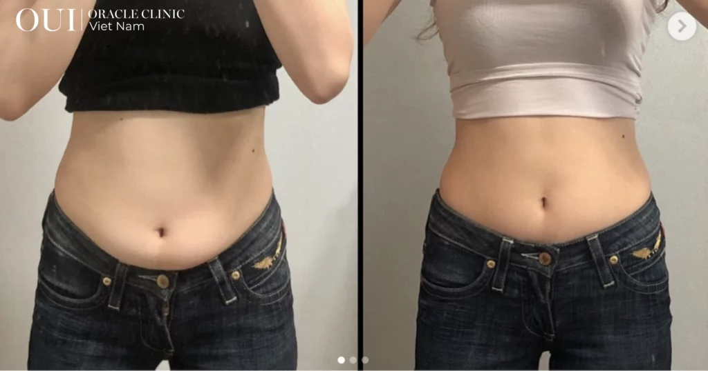 cải thiện body không tập gym