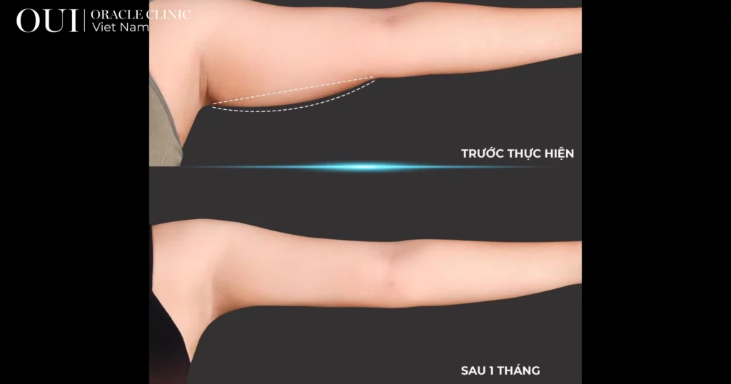 cải thiện body không tập gym