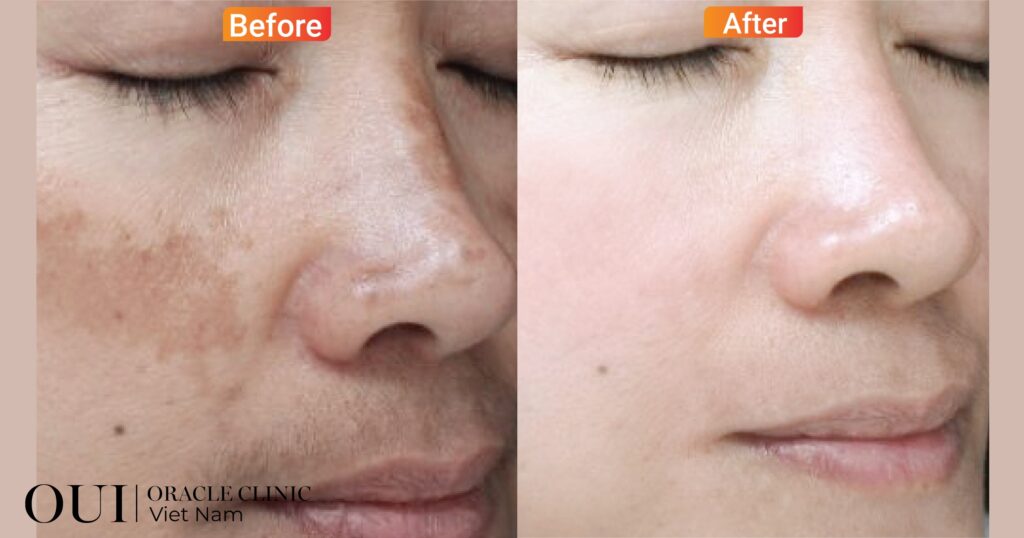 chăm sóc da định kỳ về sắc tố da