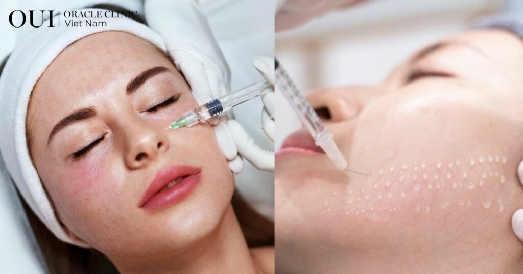 Da mất nước mùa hè tiêm Meso