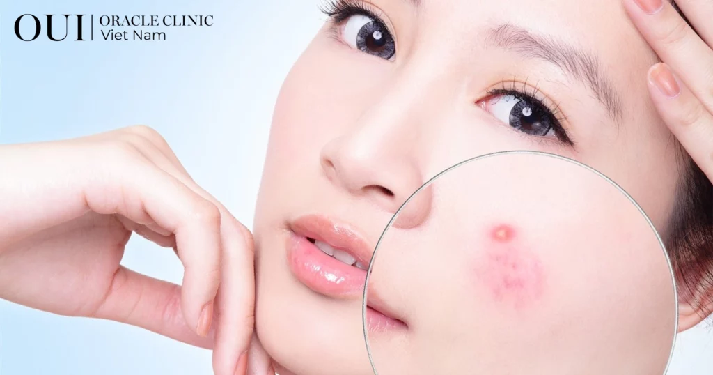 điều trị mụn không tái phát