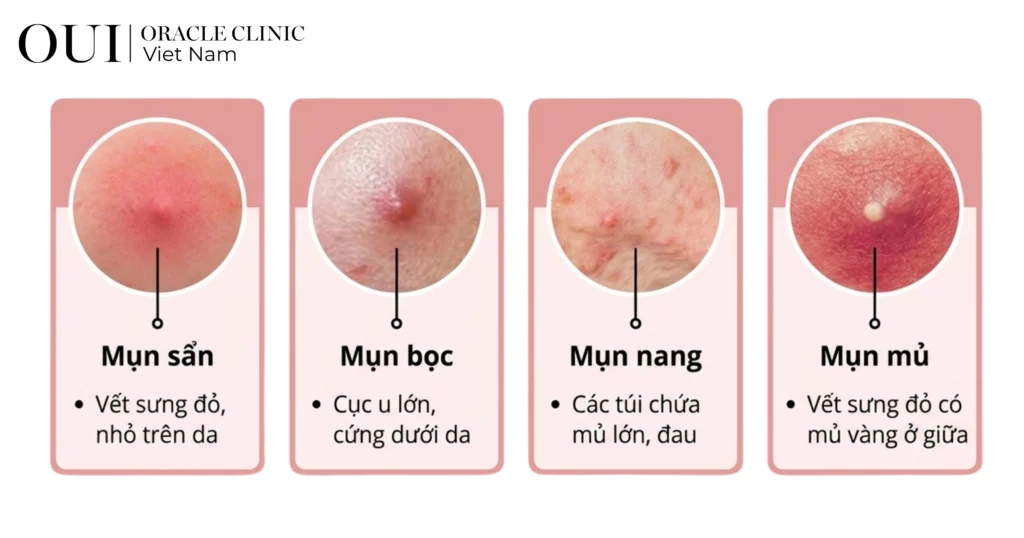 điều trị mụn không tái phát