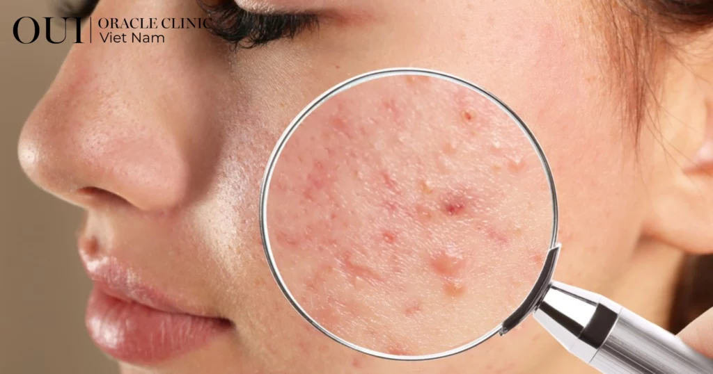 điều trị mụn không tái phát