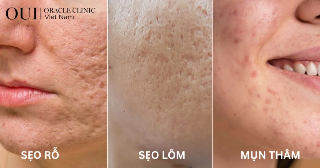 điều trị mụn không tái phát