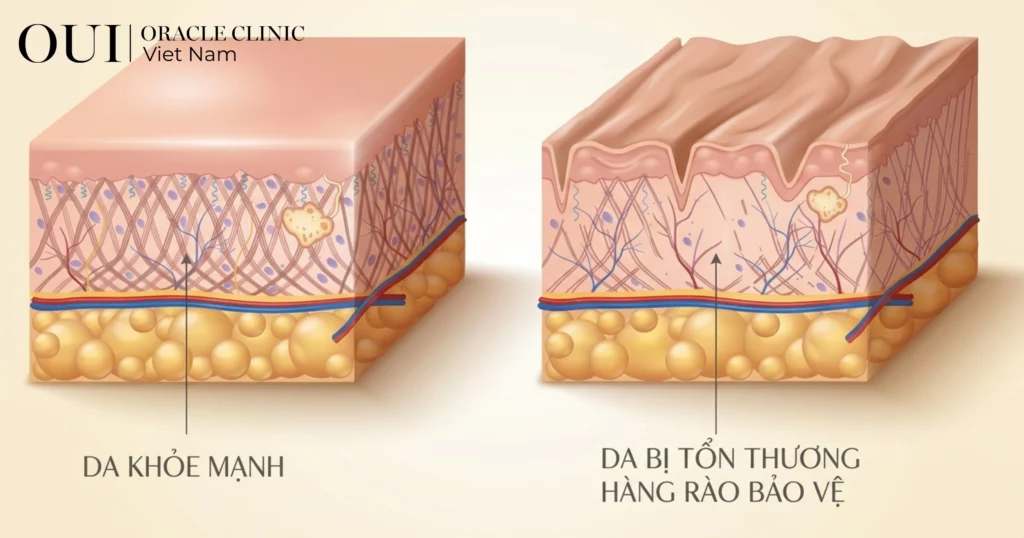 điều trị mụn không tái phát